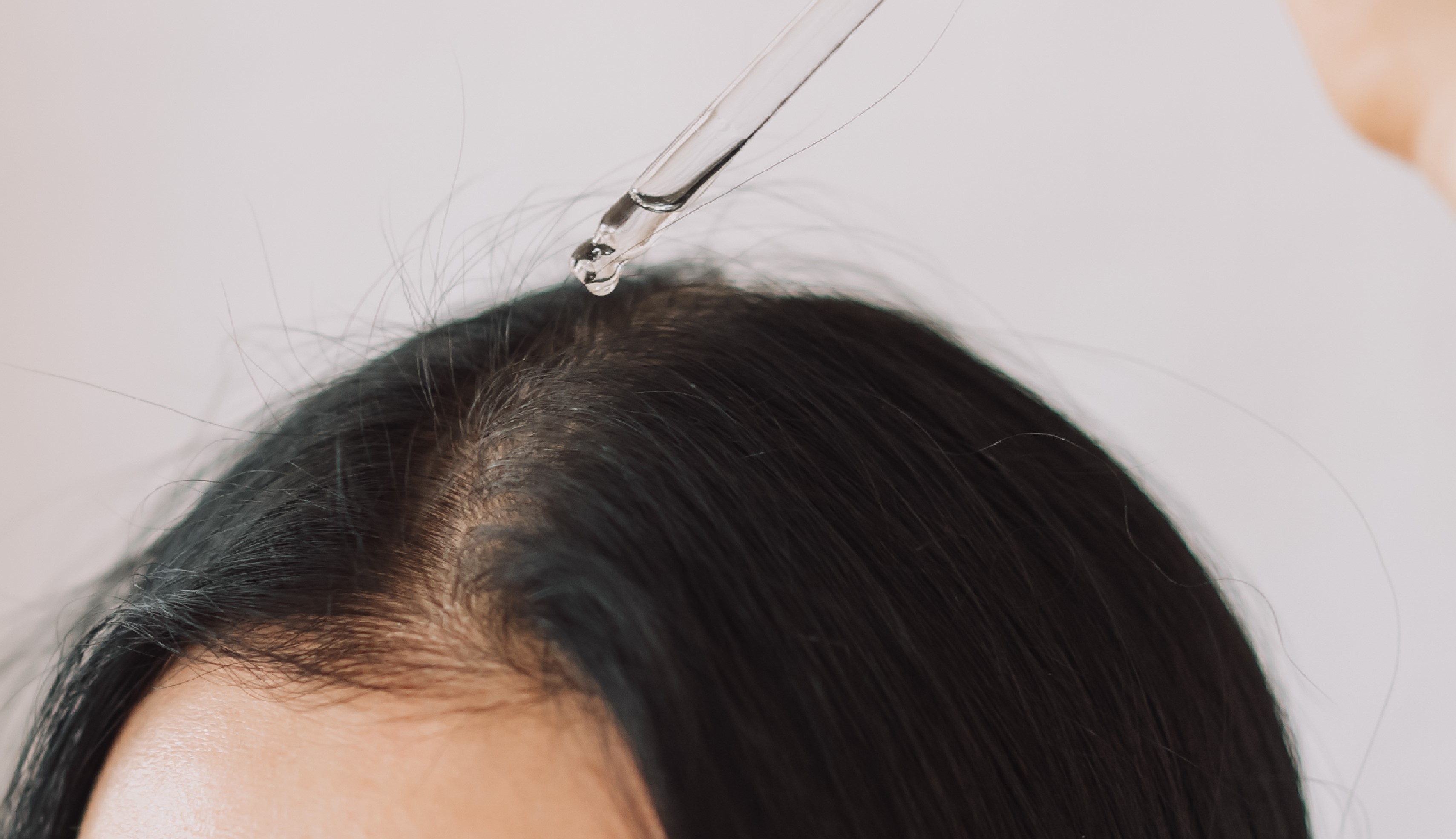 Hair Loss